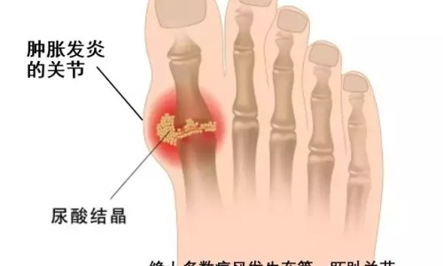 瘫痪病人双脚肿胀-瘫痪病人脚部水肿网 - 网站提供瘫痪病人脚肿腿肿怎么回事小常识、瘫痪病人脚肿了什么原因